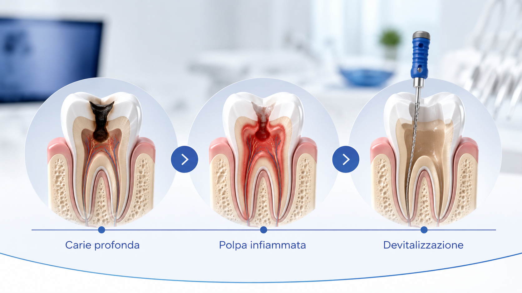 Illustrazione delle fasi da carie profonda a polpa infiammata fino alla devitalizzazione